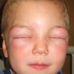 child in anaphylactic shock