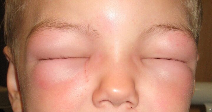 child in anaphylactic shock